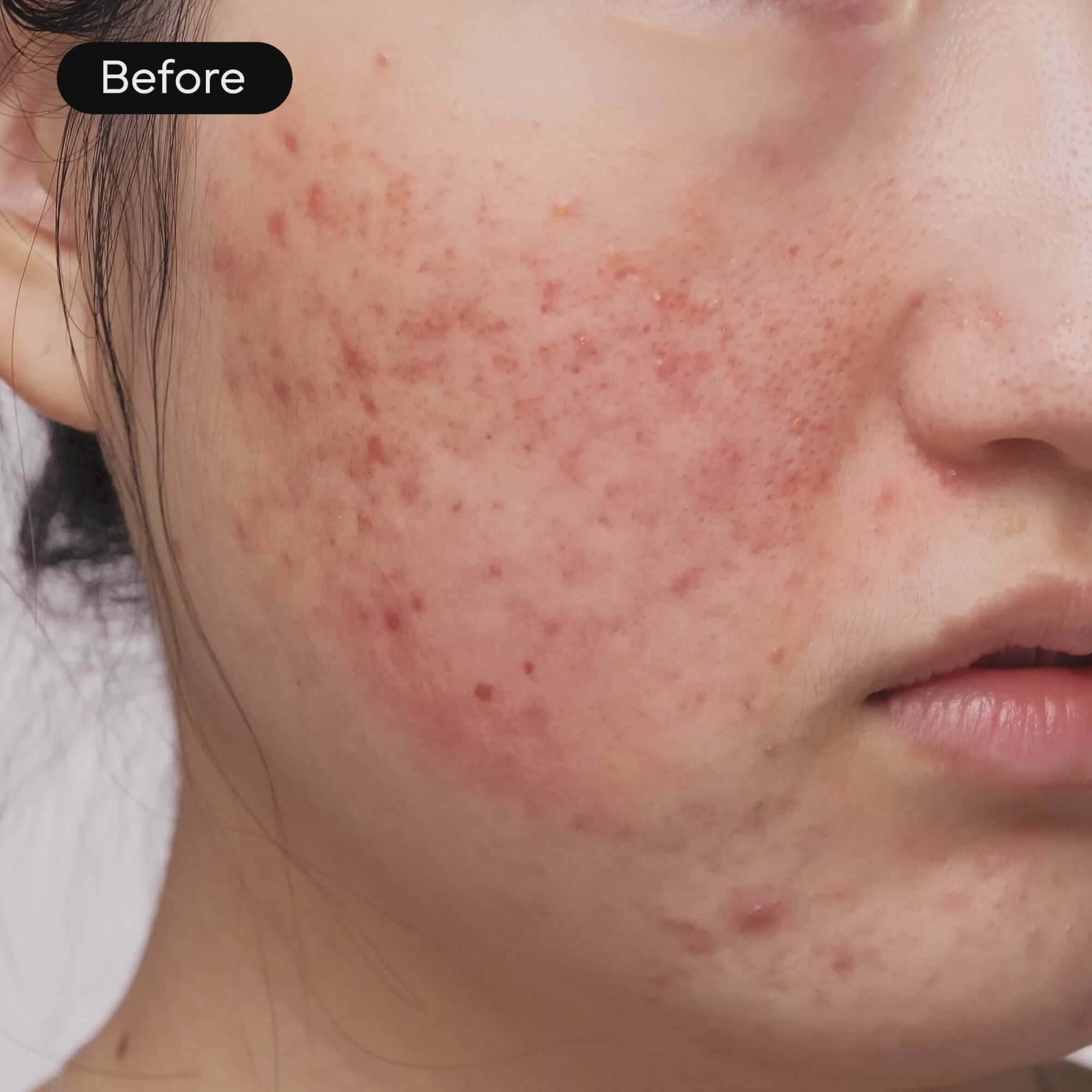 Before using Intensive Cica Repair Cream: visible redness and breakouts on facial skin.
