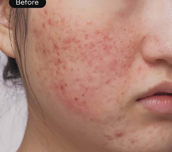 Before using Intensive Cica Repair Cream: visible redness and breakouts on facial skin.